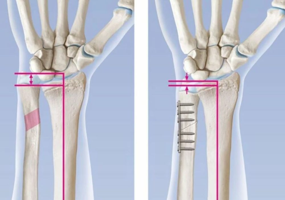 Ulno carpal impaction syndrome