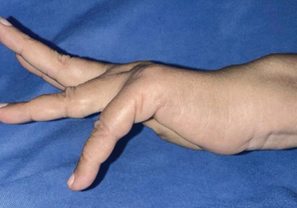 Vaughan Jackson Syndrome