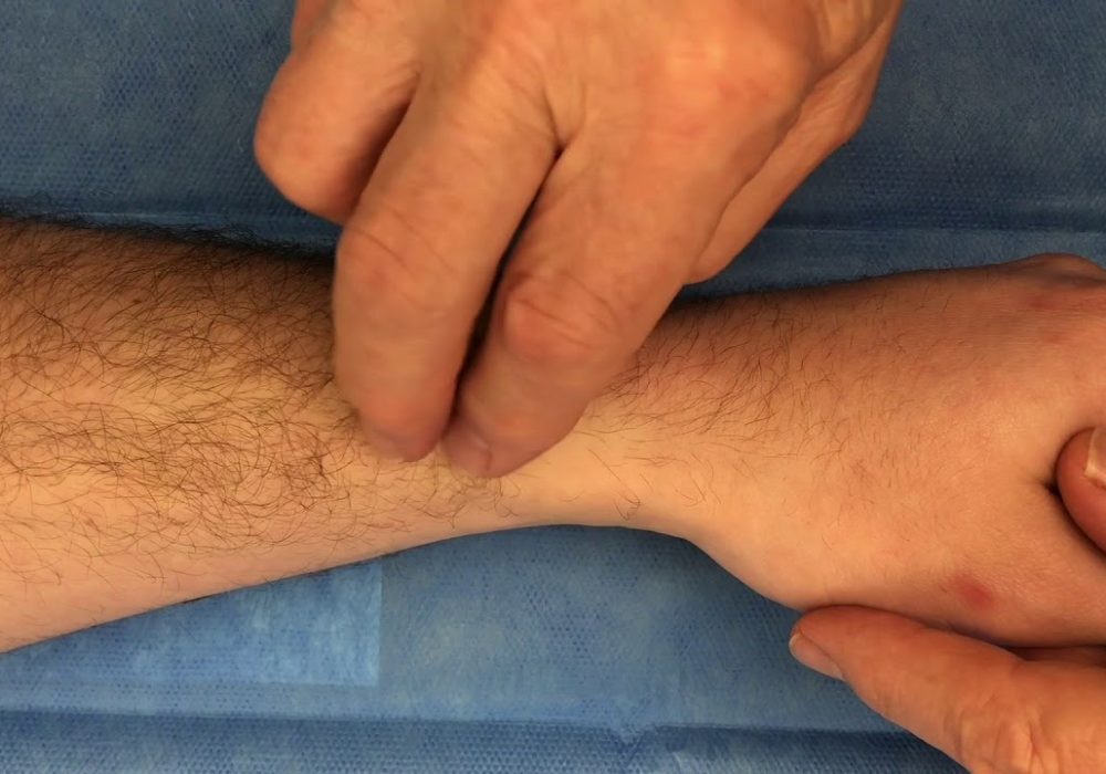 Wartenberg's Syndrome