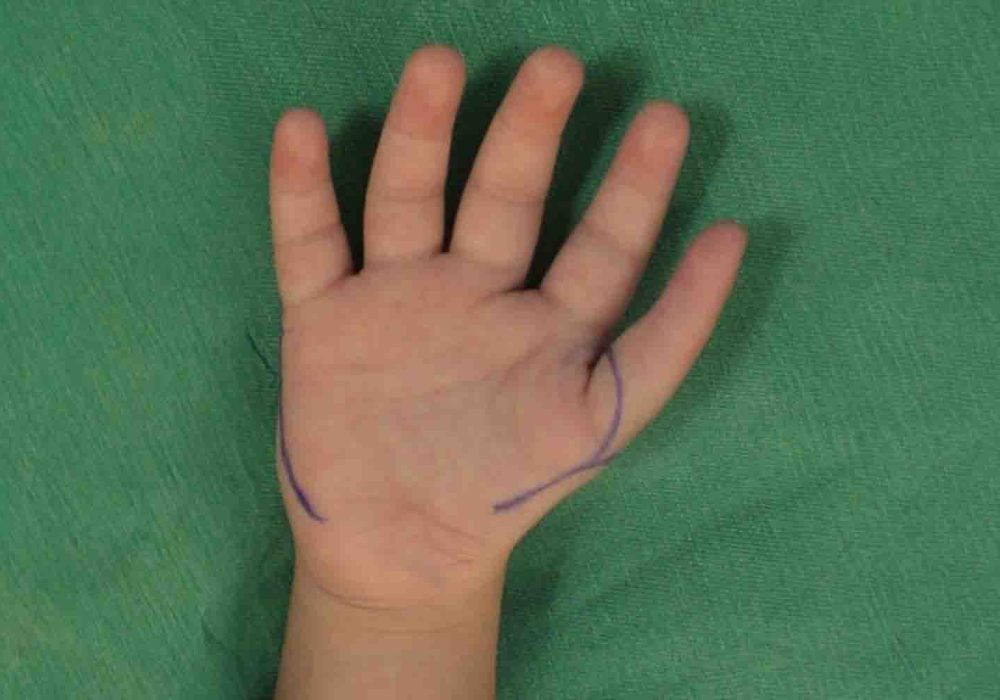 Absent / Small Thumb (Hypoplasia)