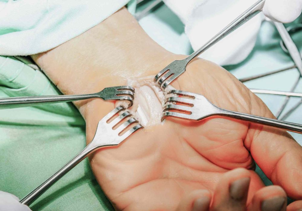 carpal_tunnel_surgery-c319cc7c2e5946dc9c40d3ed48237133