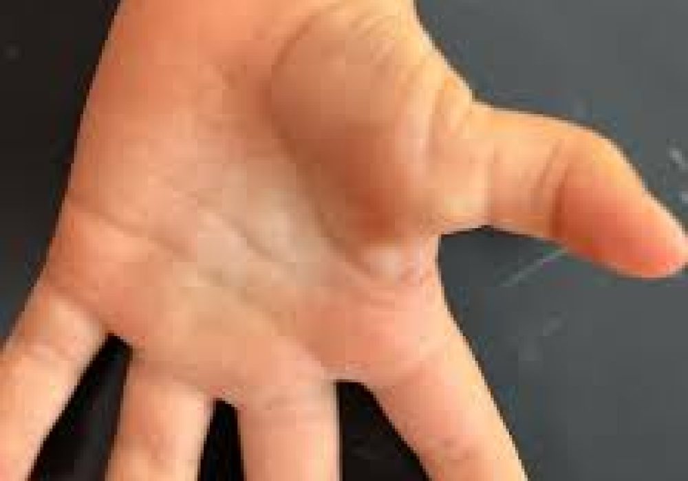 Congenital Trigger Thumb