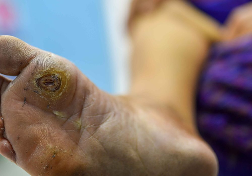 diabetic_foot_ulcer
