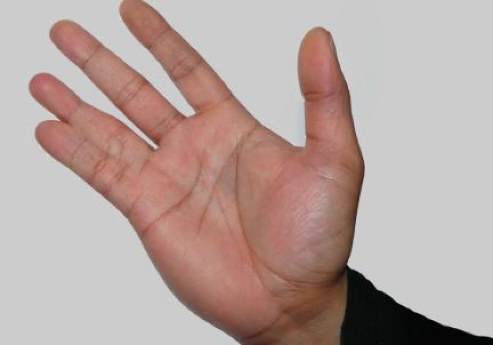 Release of Fused Fingers