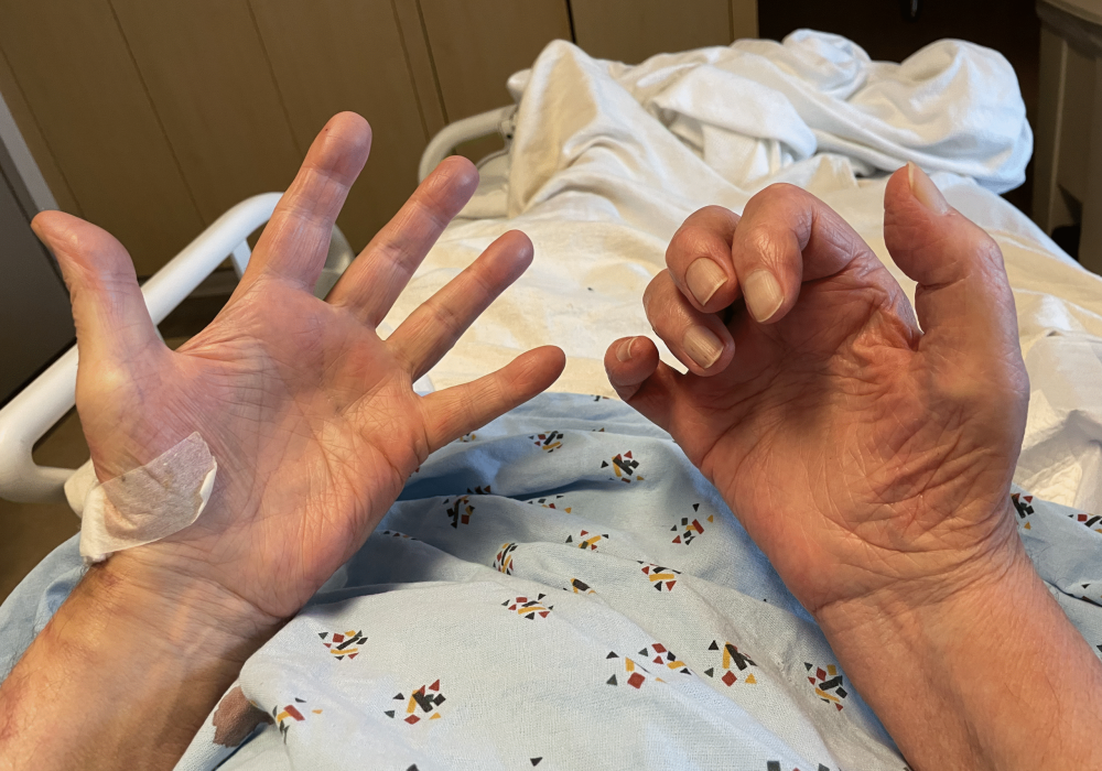 figure_1._right_(total)_claw_hand_deformity_with_wasting_of_all_intrinsic_muscles_of_the_hand__lumbr (2)