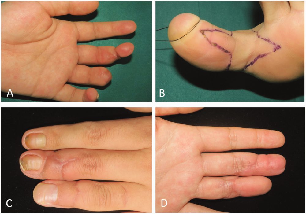 finger replantation
