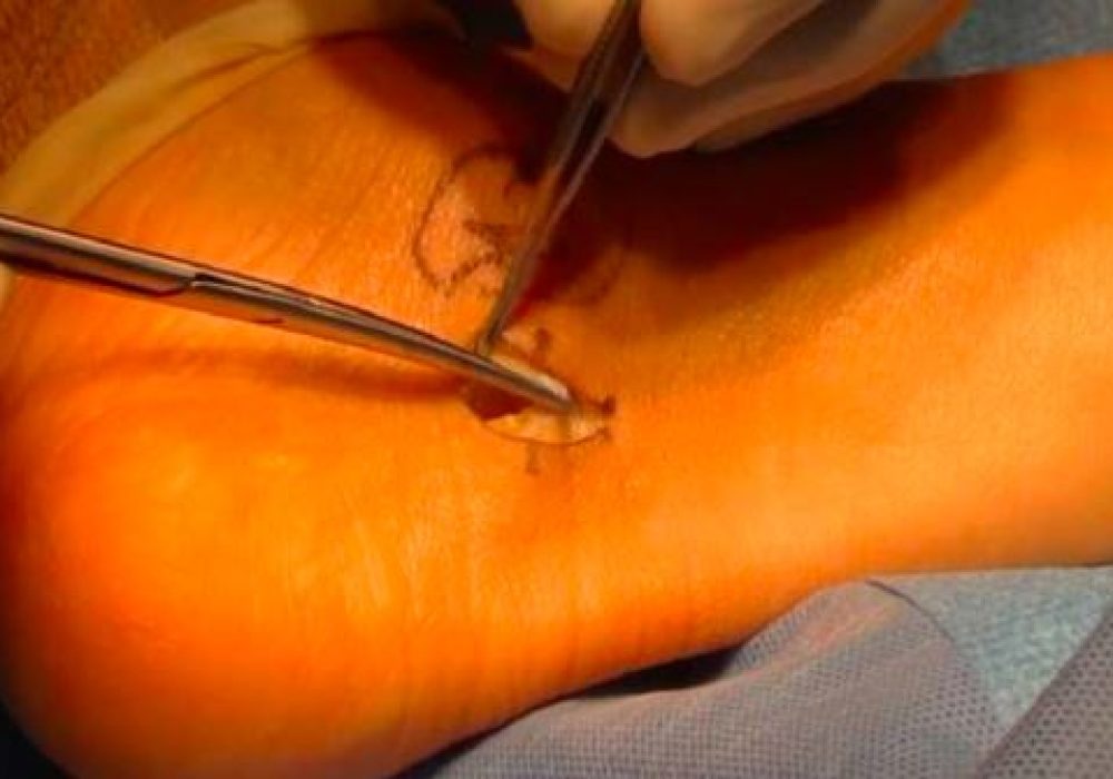 Flexor Tenosynovectomy