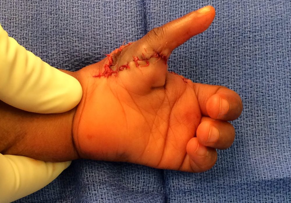 Pollicization of Thumb