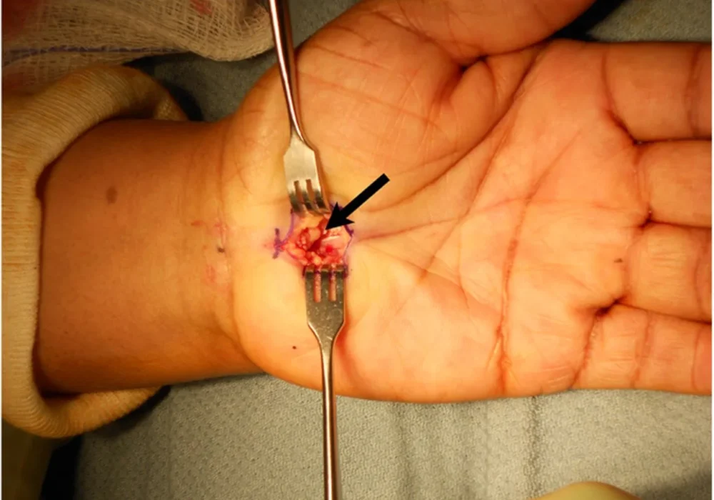 open-carpal-tunnel-release_06-19-13