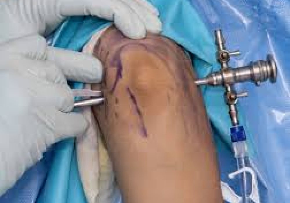Small Joint Arthroscopy