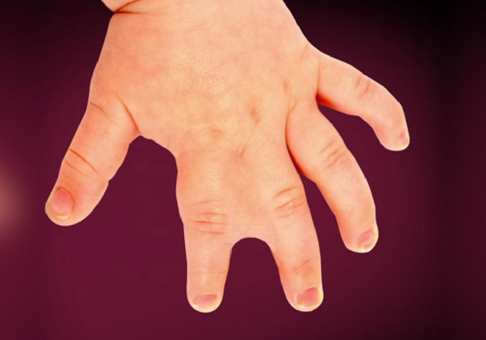Syndactyly (Fused Fingers)