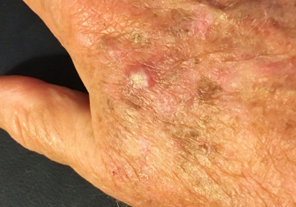 squamous-cell-carcinoma-on-the-right-hand